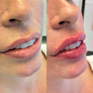 preenhimento-labial-dr-fabio-barros