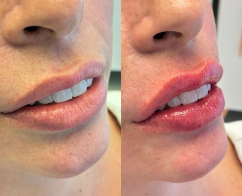 preenhimento-labial-dr-fabio-barros