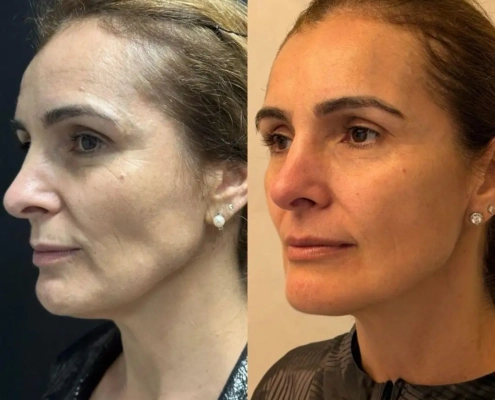 harmonizacao-facial-fullface-ipanema-dr-fabio-barros2