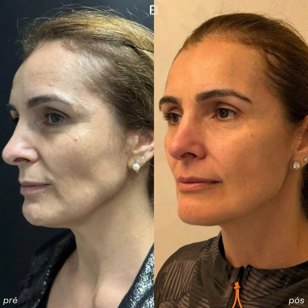 harmonizacao-facial-fullface-ipanema-dr-fabio-barros2