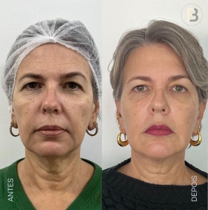 endolift-dr-fabio-barros