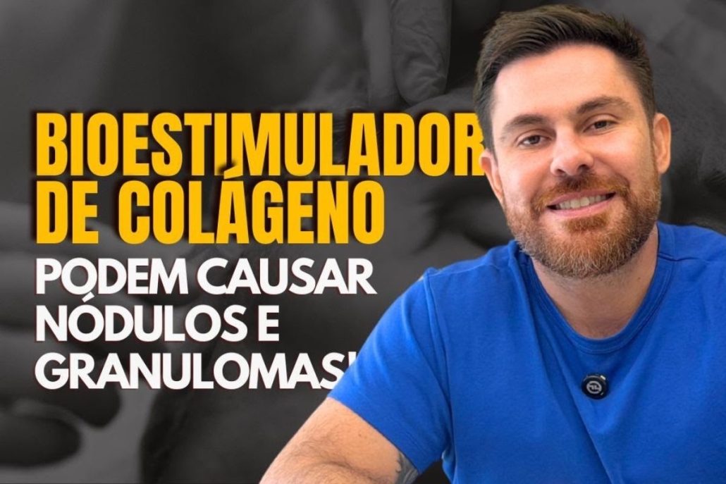 Bioestimuladores de colágeno podem causar nódulos e granulomas?