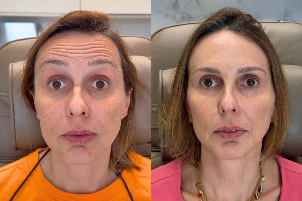 Toxina Botulínica ou Ácido Hialurônico? Entenda a Diferença e Qual é Indicado Para Cada Caso