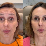 toxina-botulinica-ou-acido-hialuronico Toxina Botulínica ou Ácido Hialurônico? Entenda a Diferença e Qual é Indicado Para Cada Caso