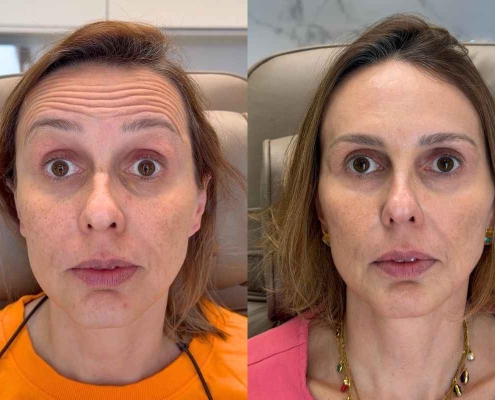 Toxina Botulínica ou Ácido Hialurônico? Entenda a Diferença e Qual é Indicado Para Cada Caso