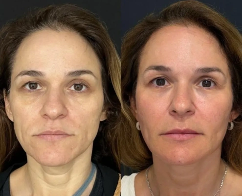 harmonizacao-facial-fullface-ipanema-dr-fabio-barros 3