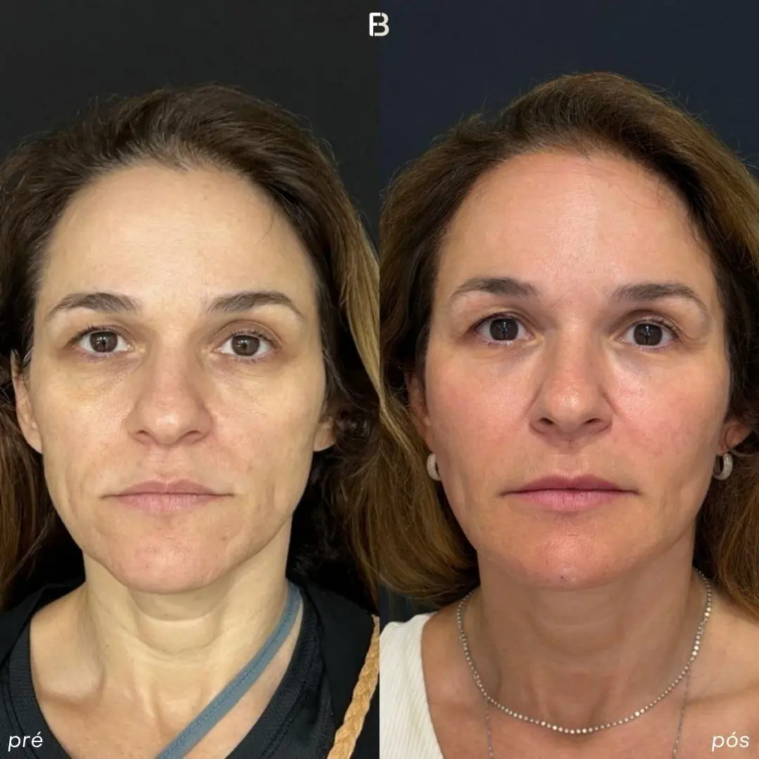 harmonizacao-facial-fullface-ipanema-dr-fabio-barros 3