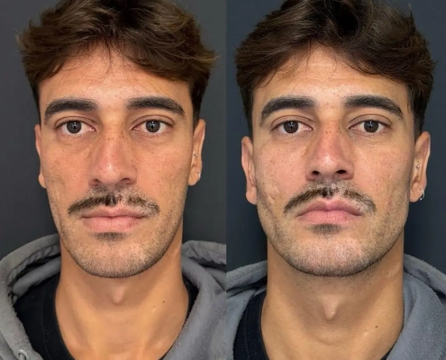 harmonizacao-facial-ipanema-mandibula-dr-fabio-barros.wepb