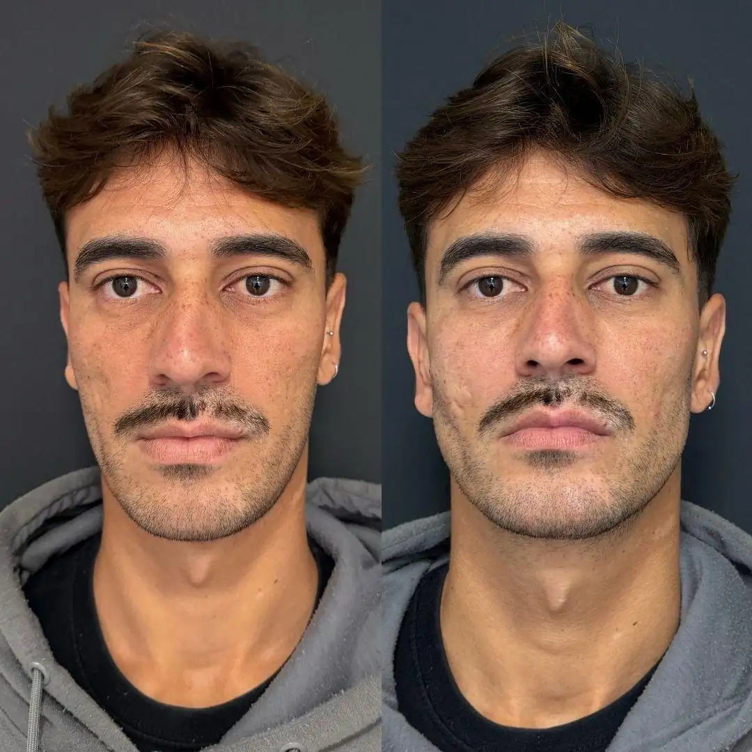 harmonizacao-facial-ipanema-mandibula-dr-fabio-barros.wepb