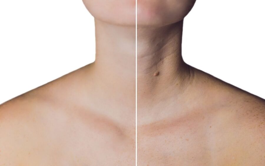 bochechas, mandíbula, queixo, têmporas