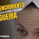 Preenchimento na testa pode causar cegueira