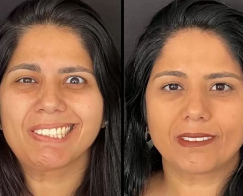 Projeto Social para Pacientes com Paralisia Facial Retorna com Apoio da Copaderma