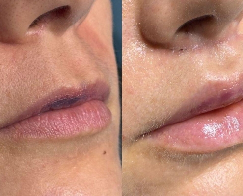 Lip Lifting: guia completo, segurança e resultados naturais